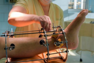 A clinician adjusting a metal brace frame on a patient's leg