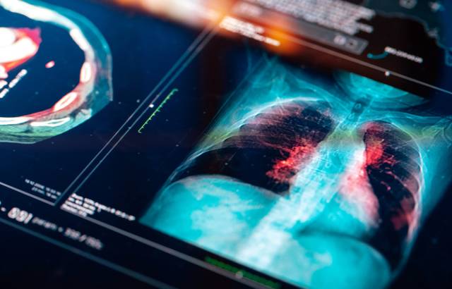 A xray image of a person's lungs