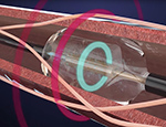 Renal denervation system