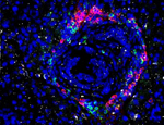 Pancreatic cancer cells being infiltrated by immune cells