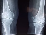 Knee x-ray. Image by Dr. Manuel González Reyesa from pixabay